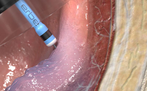 High pressure injection with HYBRIDknife® flex: Ensures consistent submucosal tissue separation, even in challenging anatomies, while isolating vasculature and reducing the risk of bleeding.